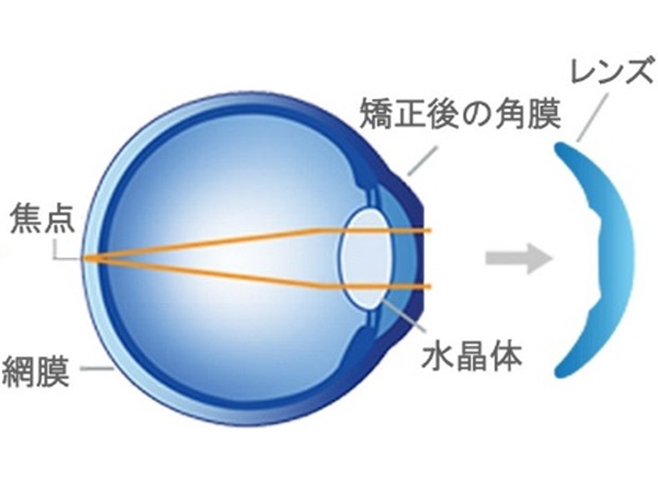 就寝中 角膜の形状を正常な屈折状態にする2