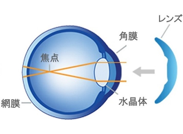 矯正前 寝る前にレンズを装用2