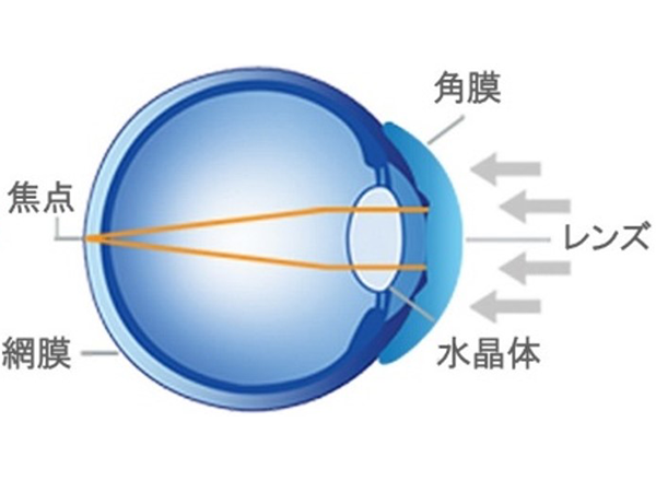 就寝中 角膜の形状を正常な屈折状態にする2